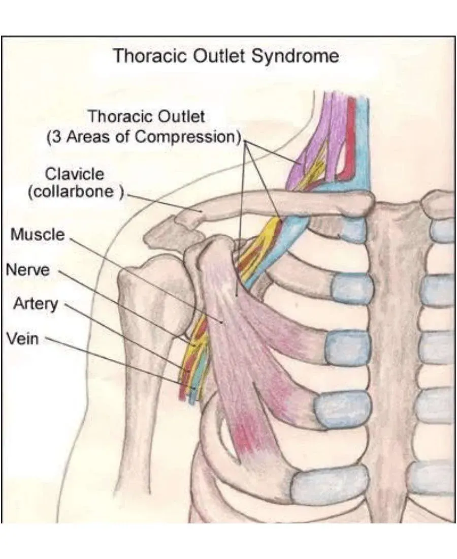 Thoracic outlet syndrome (TOS) diagram